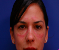 Contact Dermatitis On Face Pictures