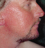 Contact Dermatitis On Face Pictures