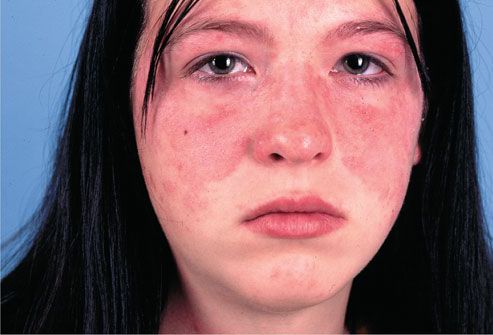 Contact Dermatitis On Face Pictures