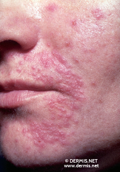 Contact Dermatitis On Face Pictures