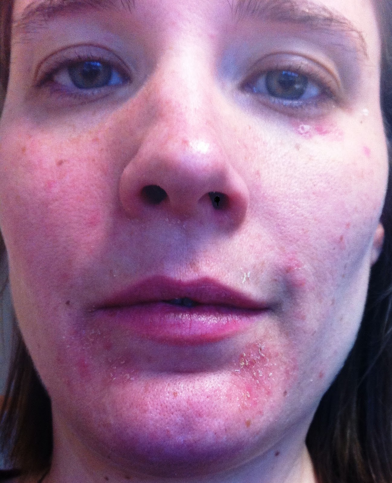 Contact Dermatitis On Face Pictures