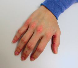 Contact Dermatitis On Face Treatment