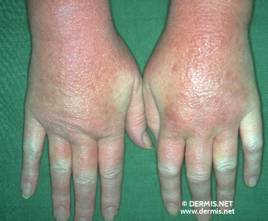 Contact Dermatitis On Hands