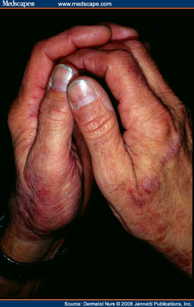 Contact Dermatitis On Hands Pictures