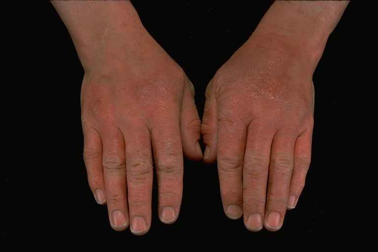 Contact Dermatitis On Hands Pictures