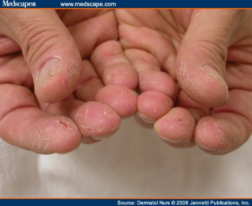 Contact Dermatitis On Hands Pictures