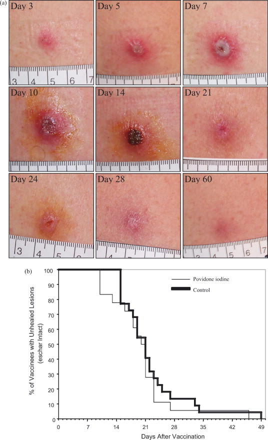 Contact Dermatitis Pictures Children