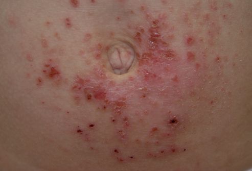 Contact Dermatitis Pictures Children