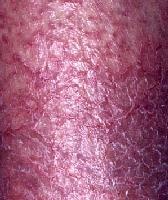 Contact Dermatitis Pictures Children