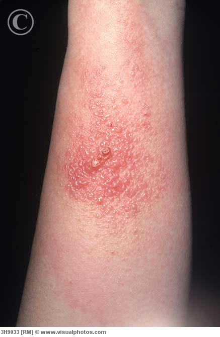 Contact Dermatitis Pictures Children