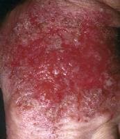 Contact Dermatitis Pictures Children