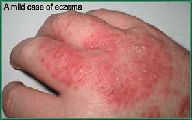 Contact Dermatitis Pictures Hands