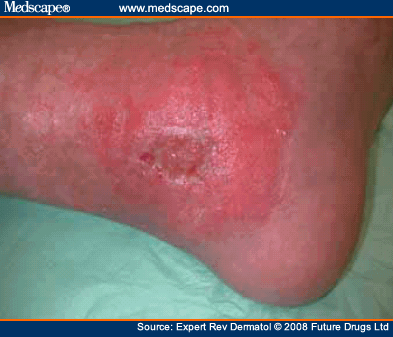 Contact Dermatitis Pictures Legs