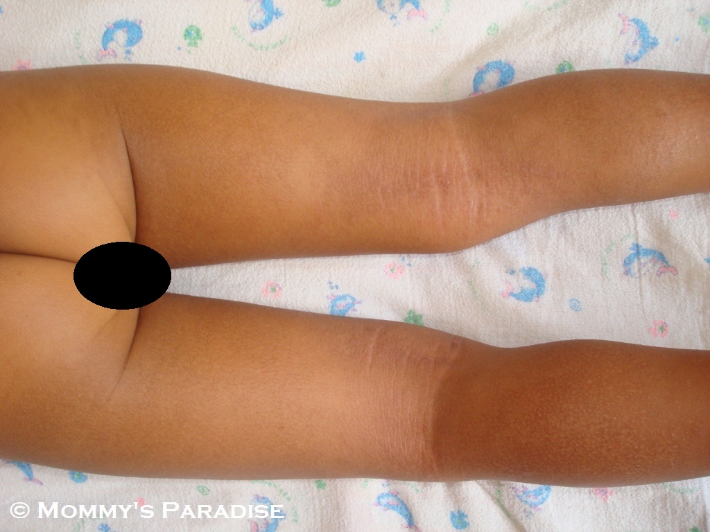 Contact Dermatitis Pictures Legs