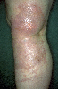 Contact Dermatitis Pictures Legs