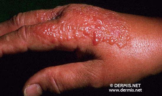 Contact Dermatitis Pictures On Back