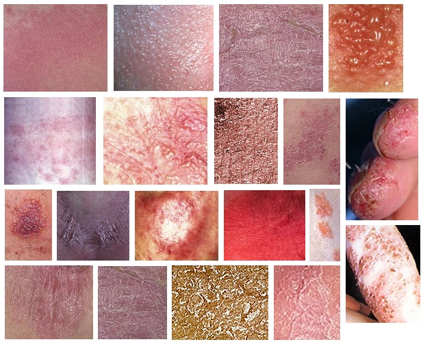 Contact Dermatitis Pictures On Back