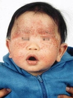 Contact Dermatitis Pictures On Face