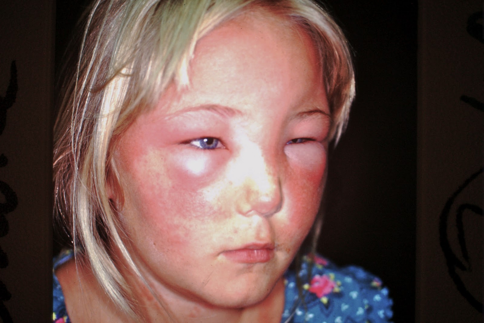 Contact Dermatitis Pictures On Face