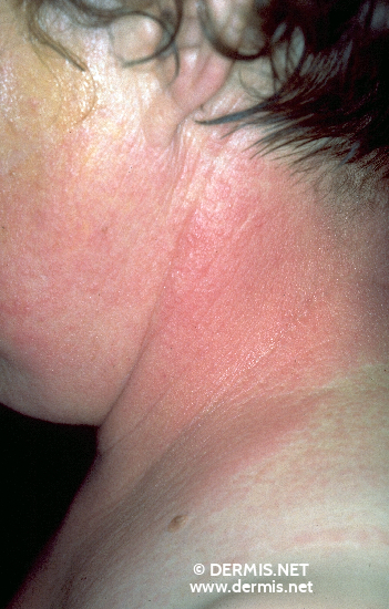 Contact Dermatitis Pictures On Neck