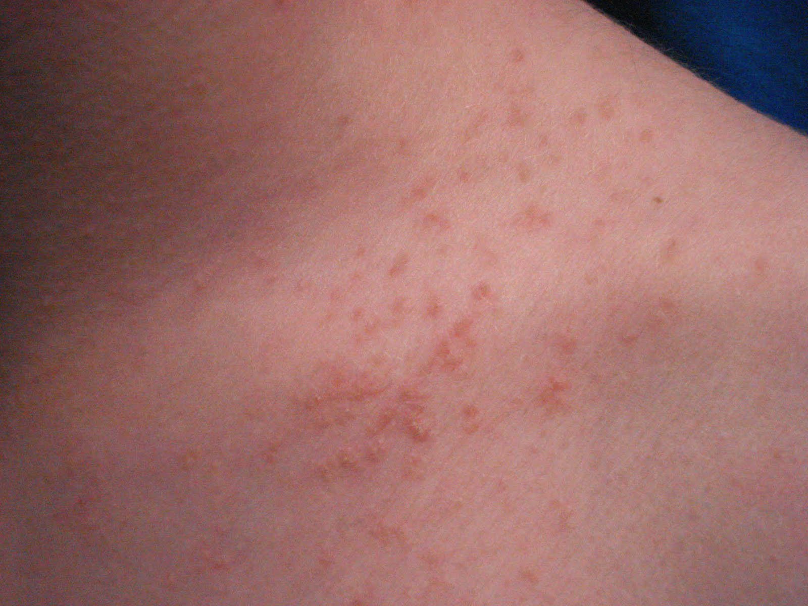 Contact Dermatitis Pictures On Neck