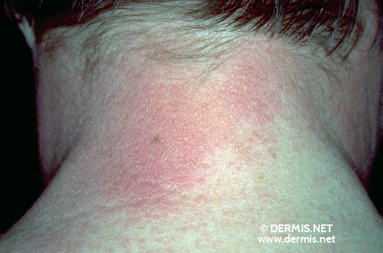 Contact Dermatitis Pictures On Neck