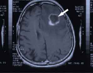 Ct Scan Brain Tumor Images