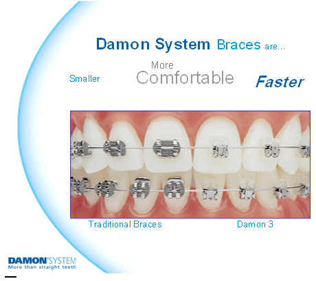 Damon Braces Cost