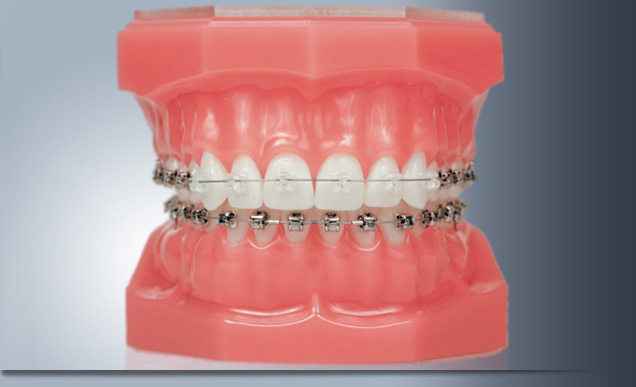 Damon Braces Cost