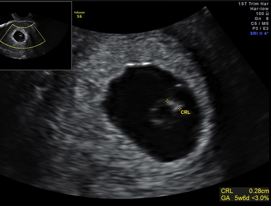 Early Miscarriage Bleeding 4 Weeks