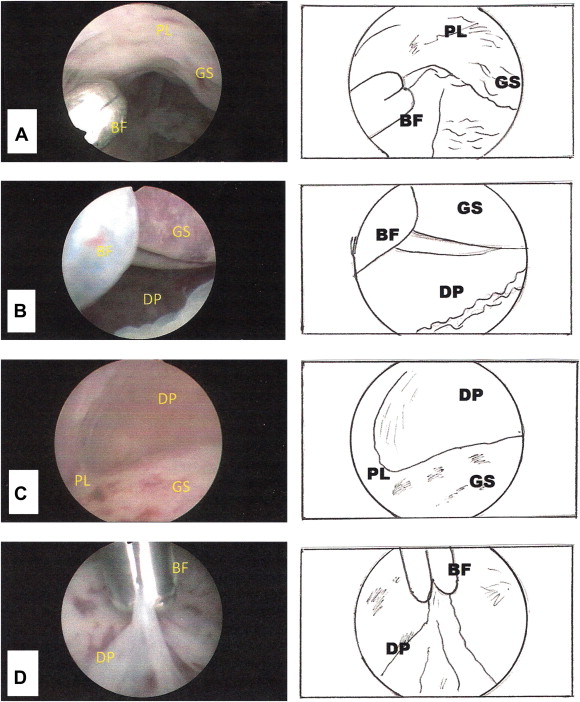 Evacuation Of Retained Products Of Conception (erpc)