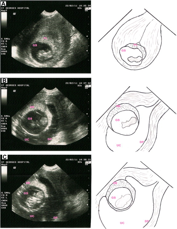 Evacuation Of Retained Products Of Conception (erpc)