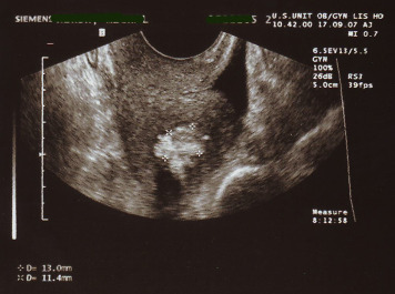 Evacuation Of Retained Products Of Conception