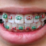 Fixed Braces Colours