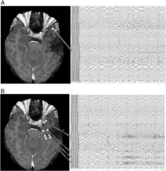 Frontal Lobe Anatomy Mri