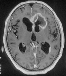 Frontal Lobe Anatomy Mri