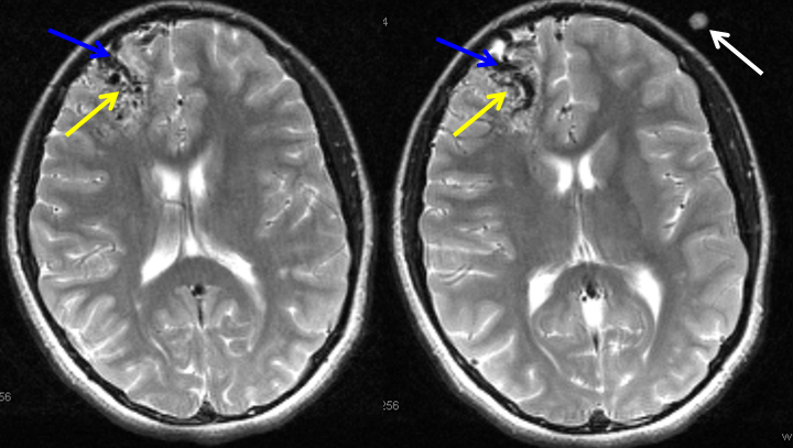 Frontal Lobe Anatomy Mri