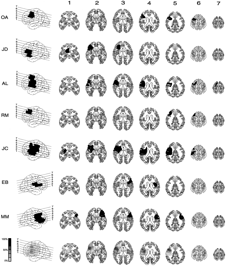 Frontal Lobe Damage