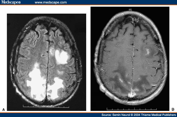 Frontal Lobe Damage