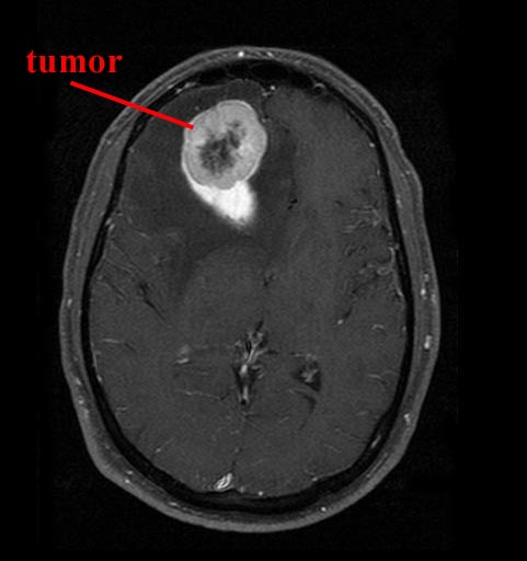 Frontal Lobe Damage