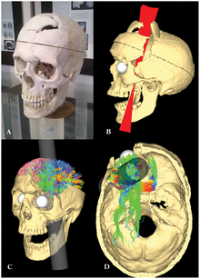 Frontal Lobe Damage Sociopath