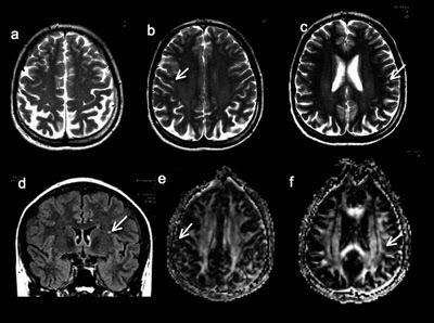 Frontal Lobe Damage Symptoms