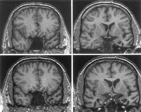 Frontal Lobe Dementia