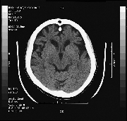 Frontal Lobe Dementia Causes