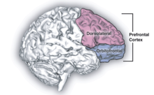 Frontal Lobe Dementia Causes