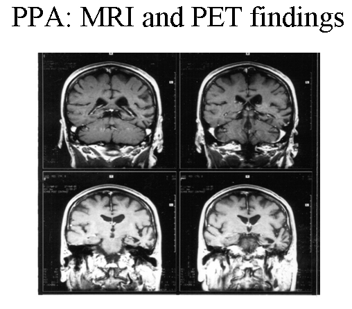 Frontal Lobe Dementia Causes