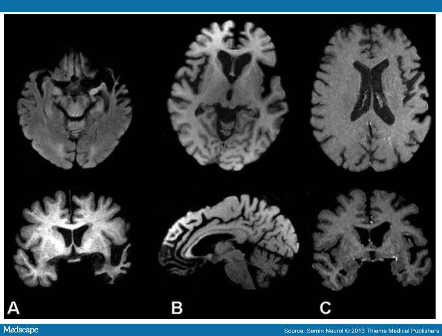 Frontal Lobe Dementia Causes