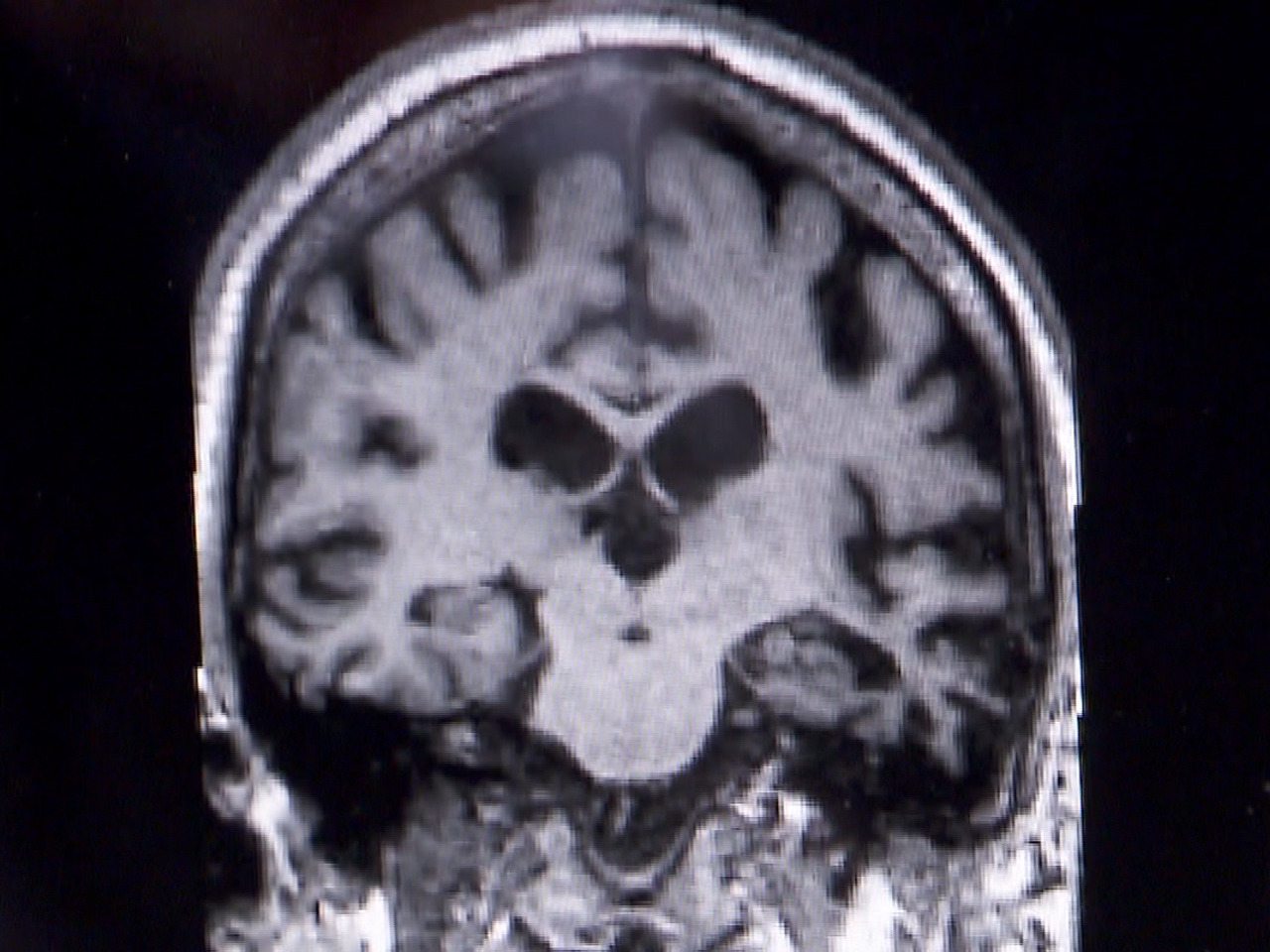 Frontal Lobe Dementia Stages