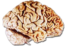 Frontal Lobe Dementia Stages