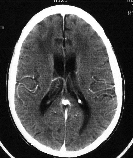 Frontal Lobe Dementia Symptoms